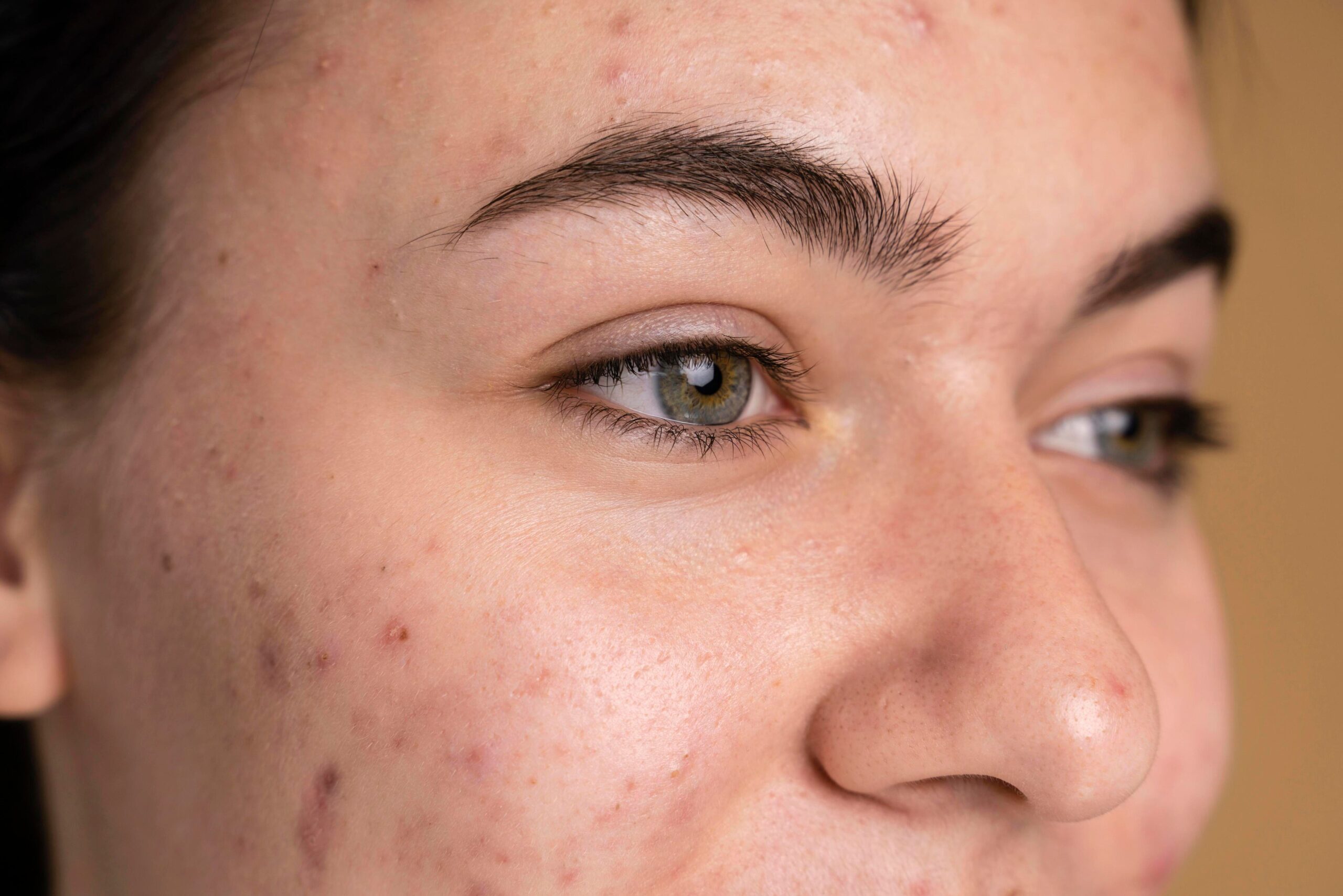 https://skintoheart.com/cdn/shop/articles/confident-young-woman-with-acne.jpg?crop=center&height=2735&v=1757171141&width=4100